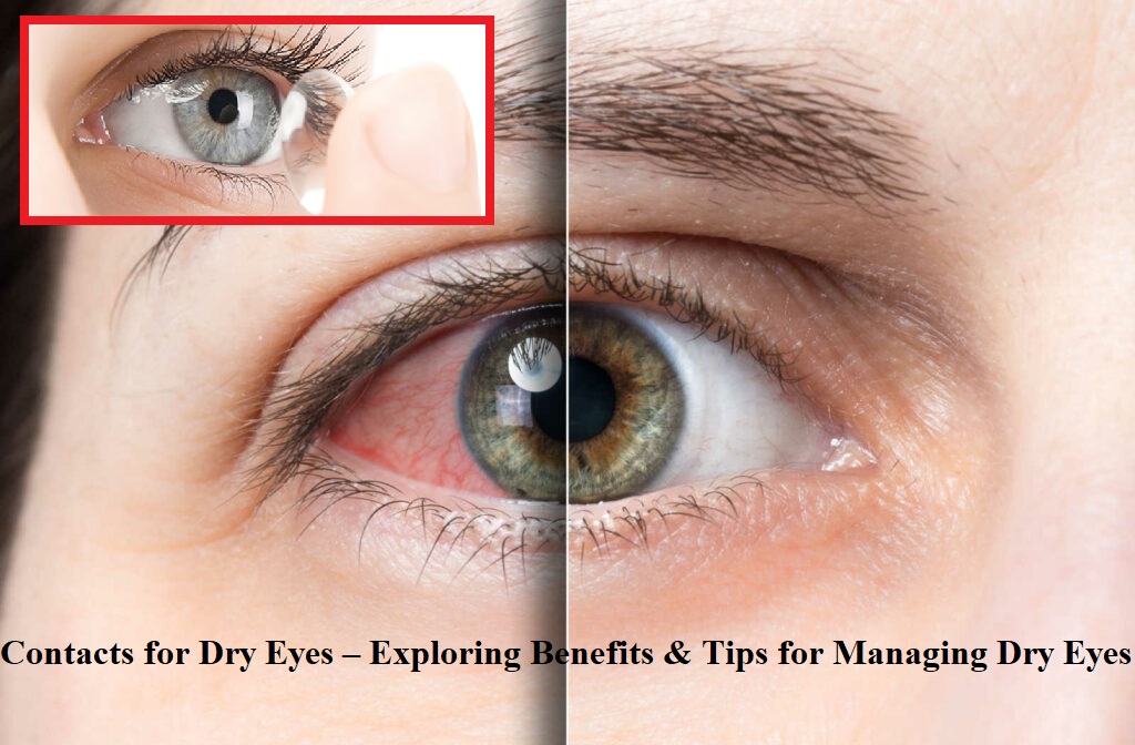 Contacts for Dry Eyes – Exploring Benefits & Tips for Managing Dry Eyes